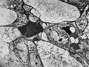 F,49y. | hemangioblastoma - brain